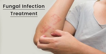 Fungal Infection Treatment in Ahmedabad